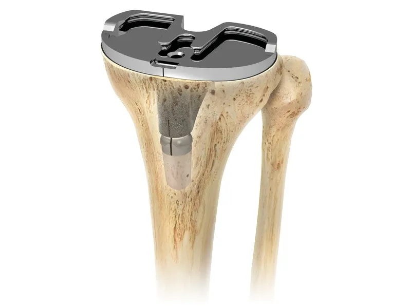 Personalized implants